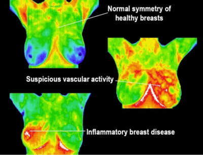 thermography2
